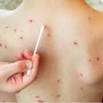 México concentra 42% de casos de sarampión en América; viajes internacionales impulsan brote