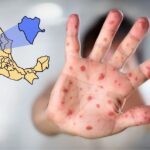 Reportan 185 casos de sarampión en Durango; Mezquital y capital concentran la mayoría