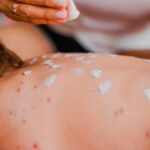 México registra 35 muertes por sarampión y primer fallecimiento asociado a miasis