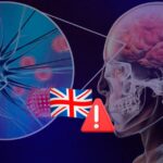 Reportan brote de meningitis en Canterbury con 29 casos y dos fallecidos