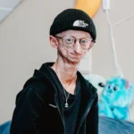 Muere Michiel Vandeweert, influencer belga con progeria que superó el pronóstico de vida